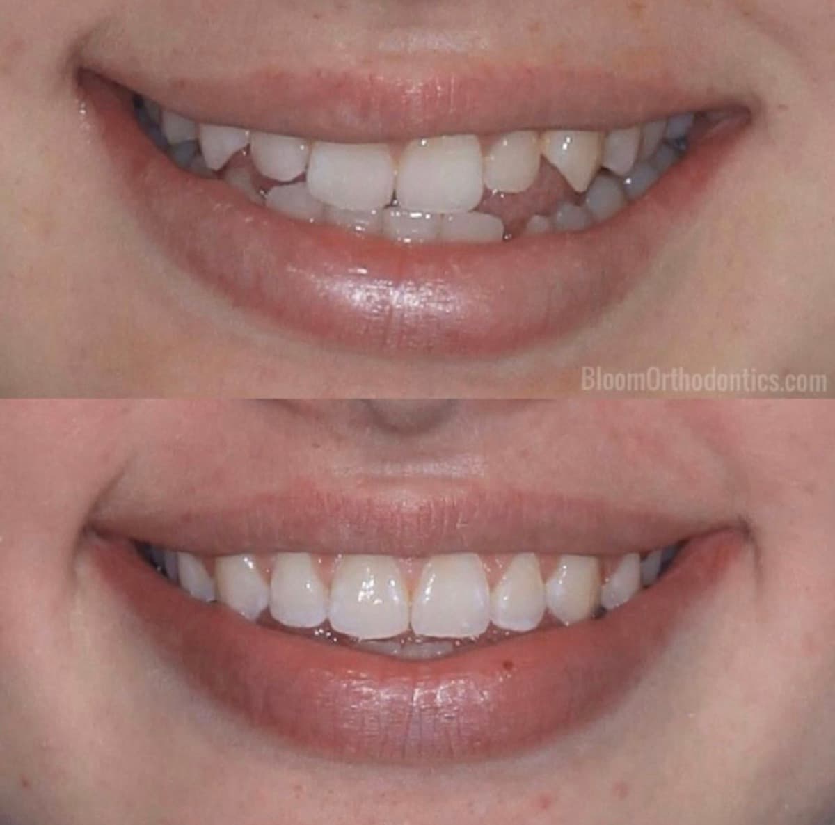 Crowding & Misalignment Correction — before and after