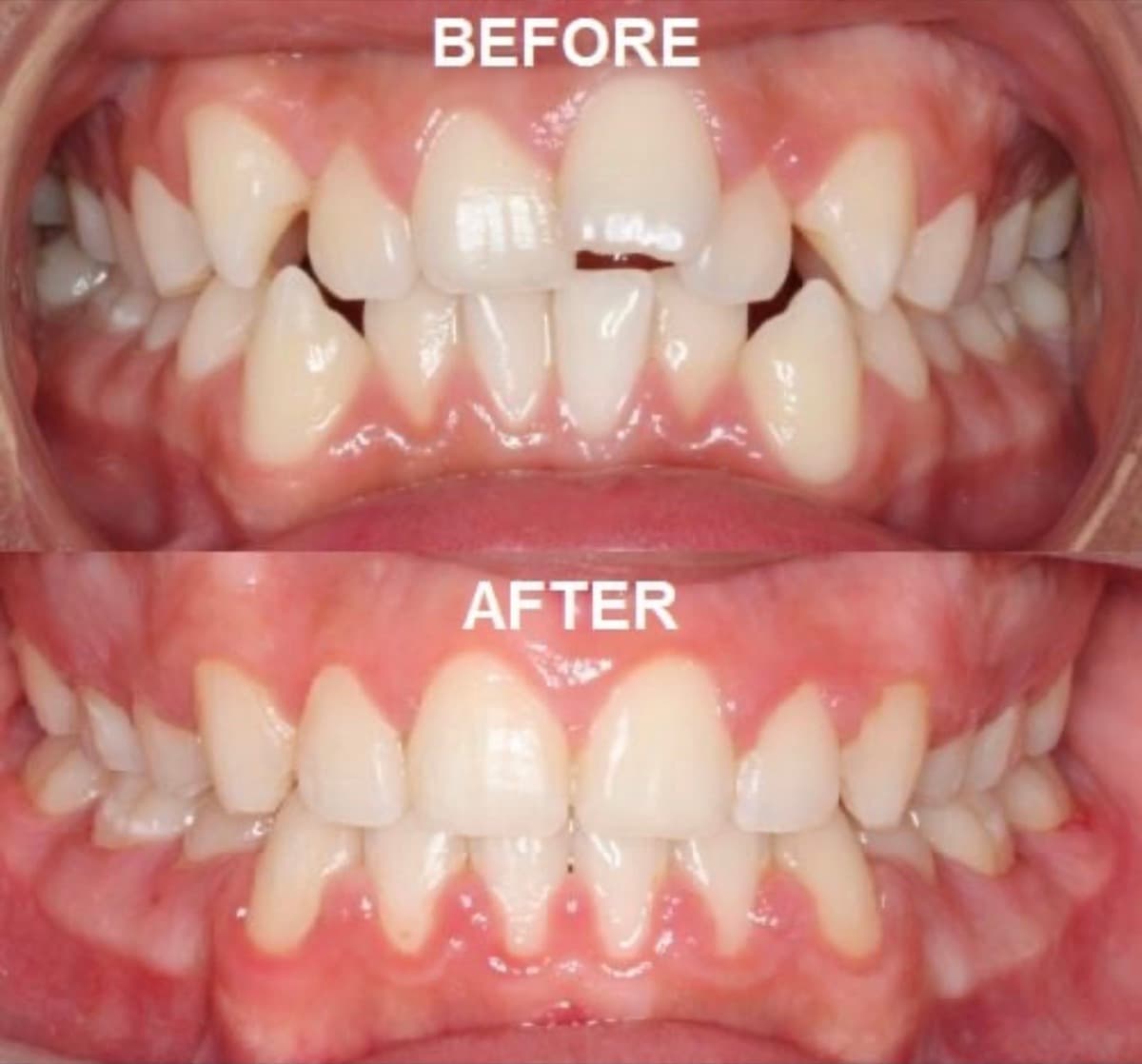 Severe Crowding — Front View — before and after