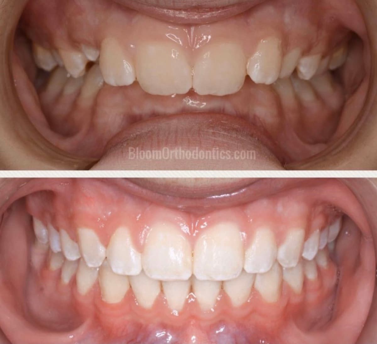 Severe Crowding Correction — before and after