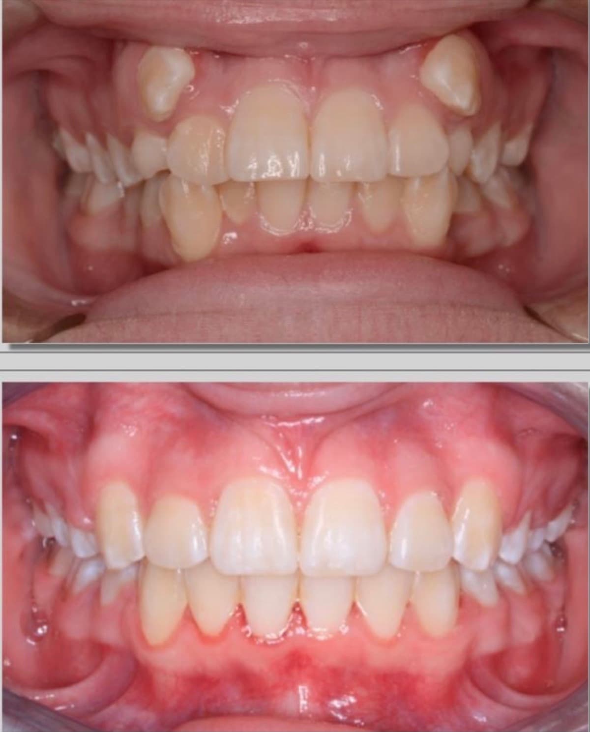 Crowding with Open Bite — before and after