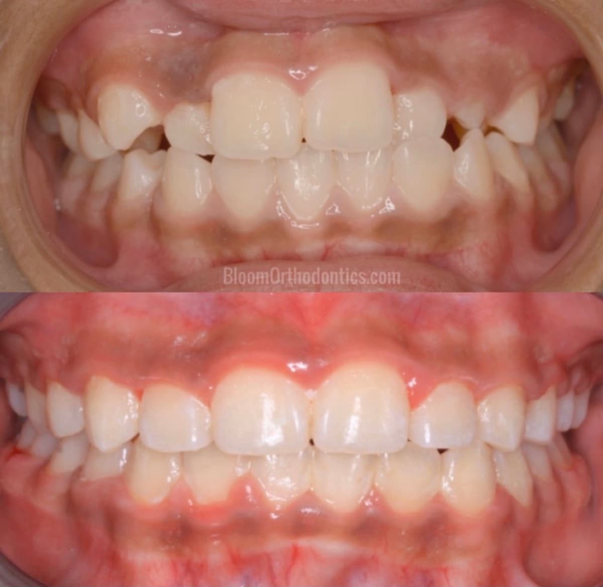 Severe Crowding & Rotation — before and after