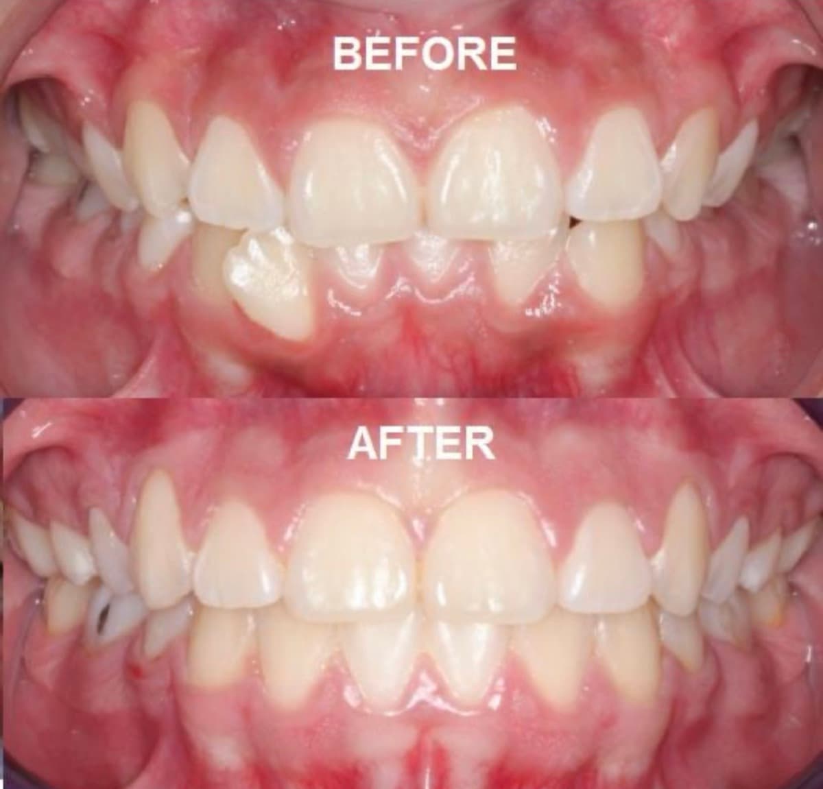 Crowding & Crossbite — before and after