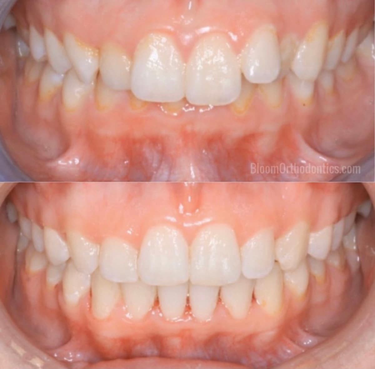 Lateral Crowding — Side View — before and after