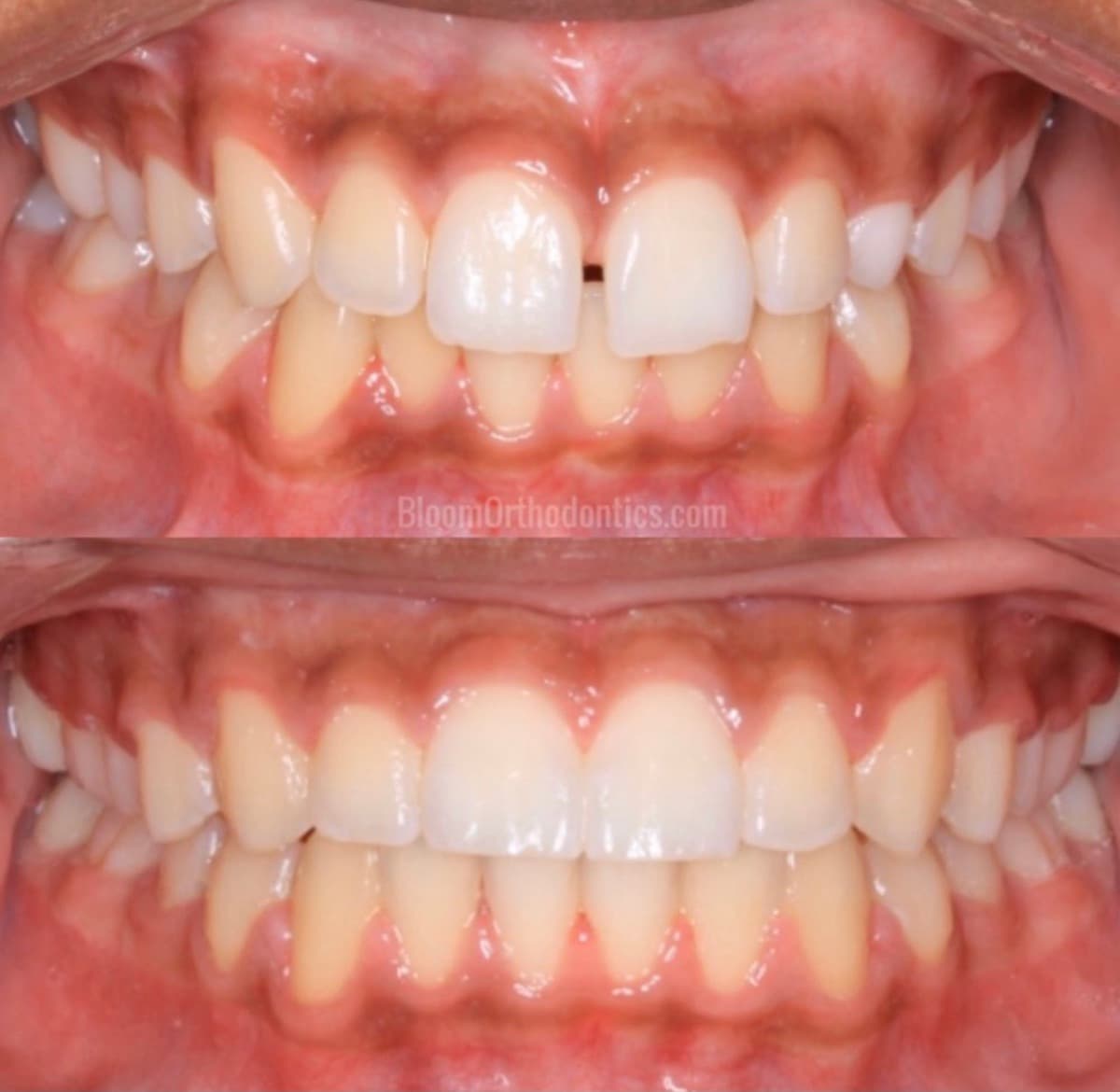 Gap Closure & Alignment — before and after