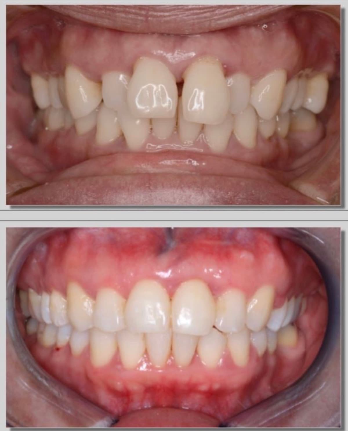 Complex Crowding — before and after