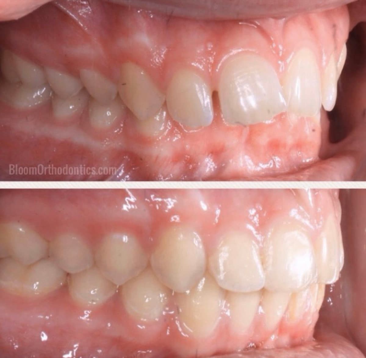 Crowding Correction — before and after