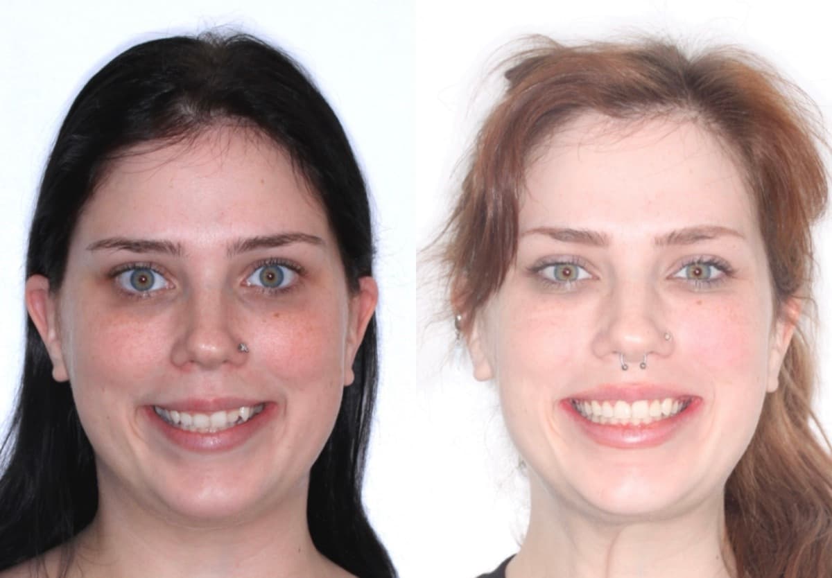 Full Smile Transformation — before and after
