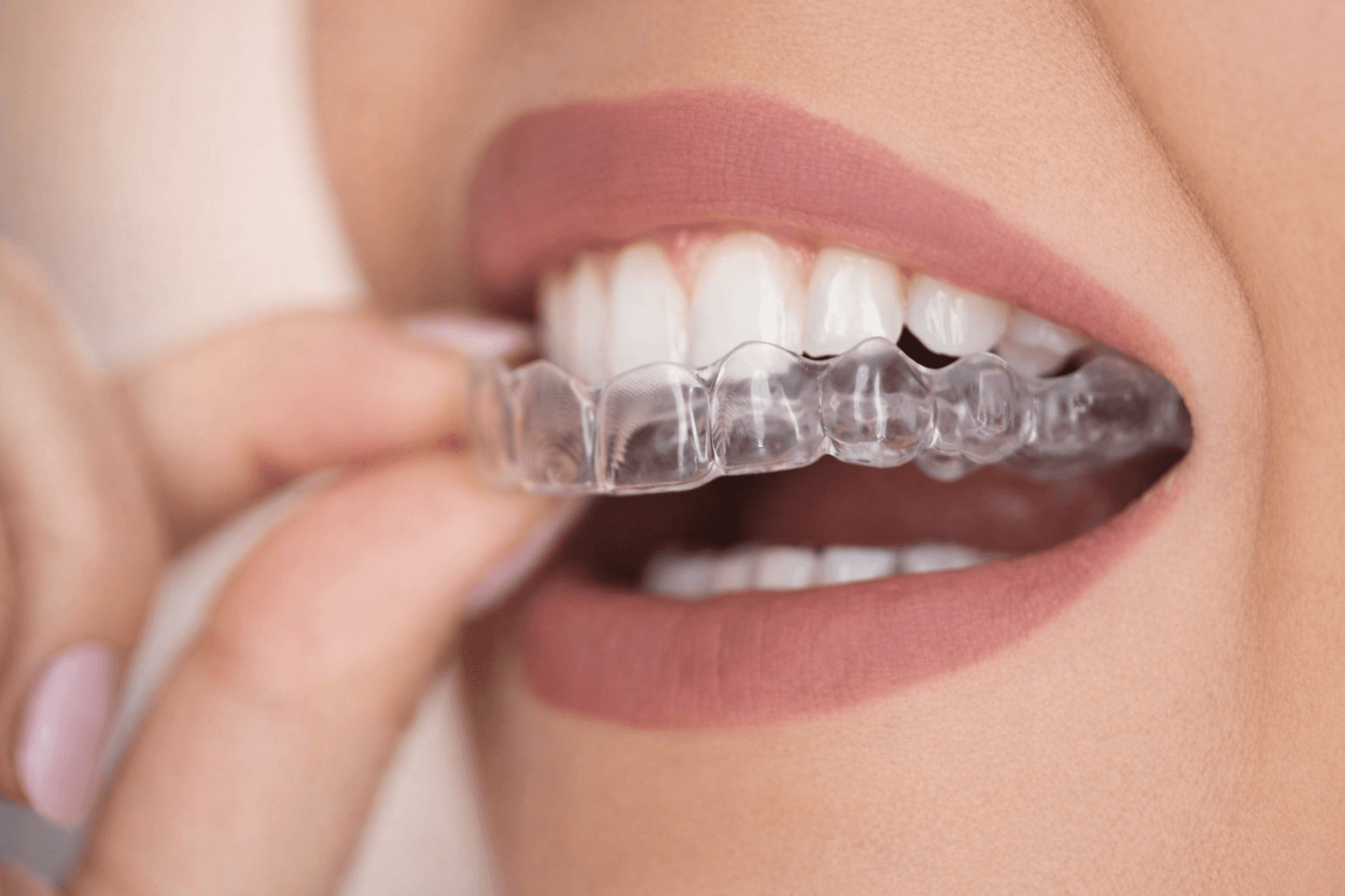 Clear Aligners at Bloom Orthodontics & Bloom Smile Studio