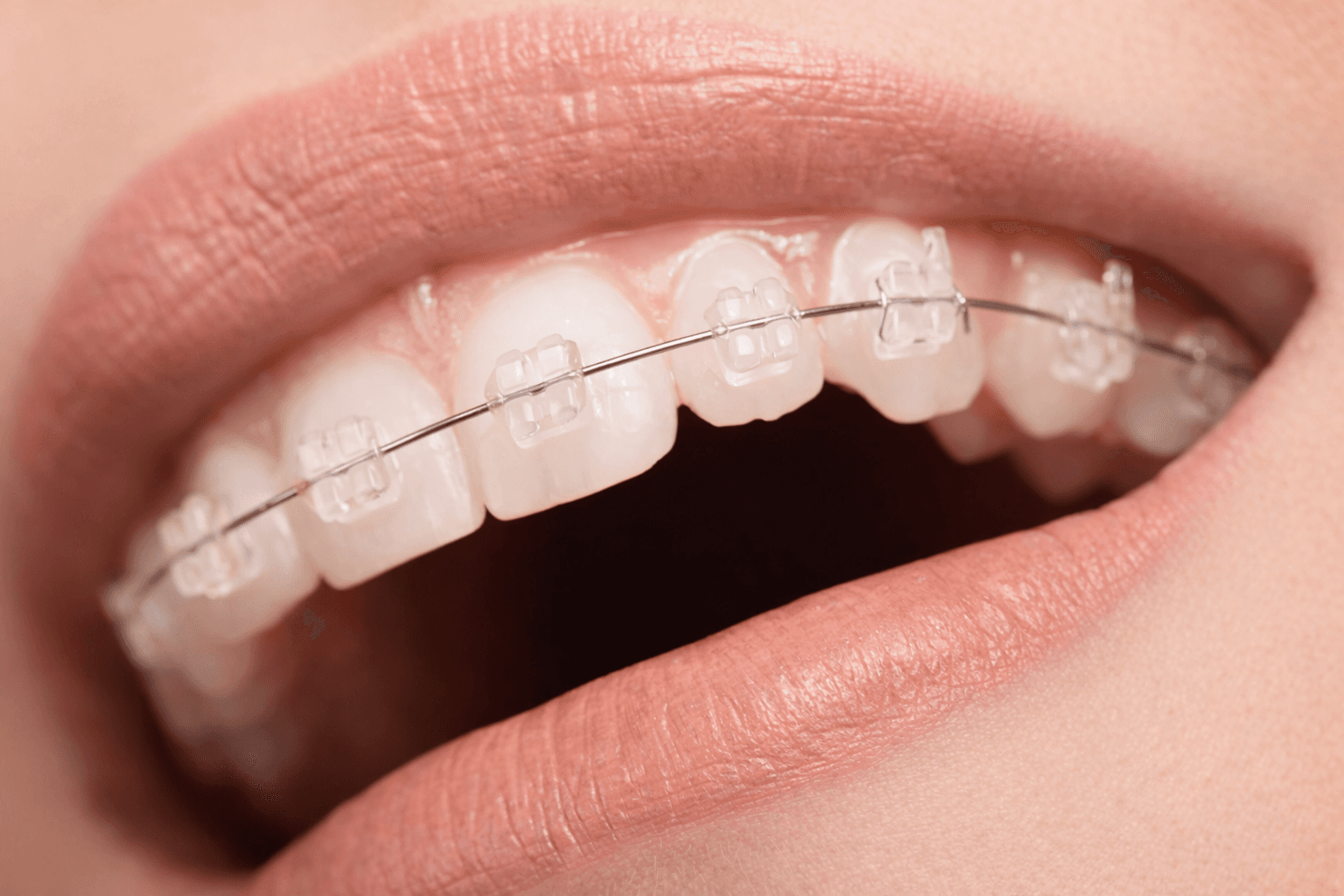 Clear Braces vs Metal Braces: Cost, Look, and Care