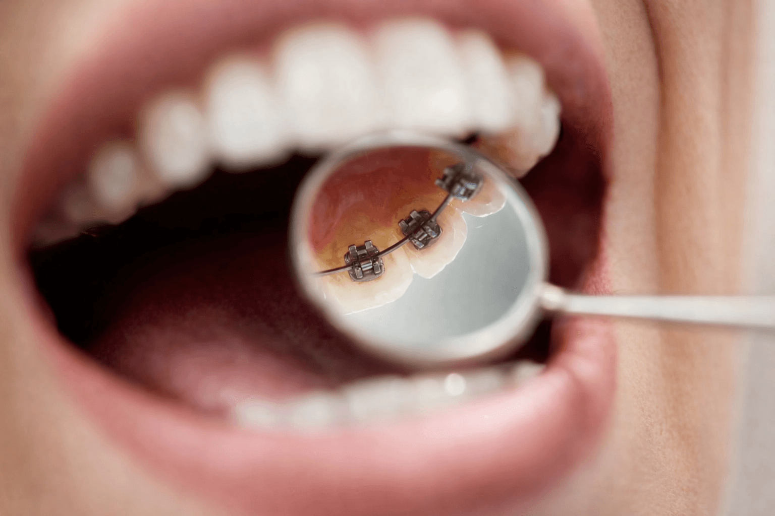 Lingual Braces